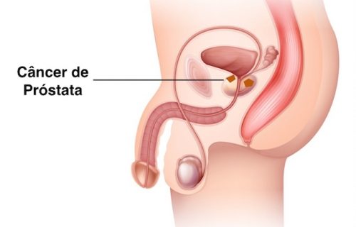 a-prostata_13257_l.jpg