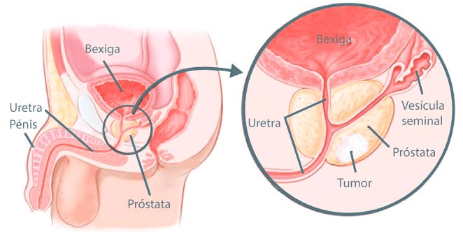 prostatectomia