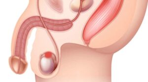 Cistos no Testículo