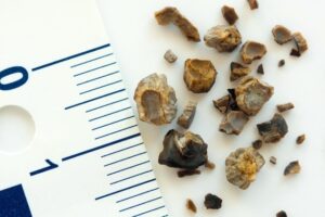 Pedra nos Rins