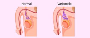 varicocele